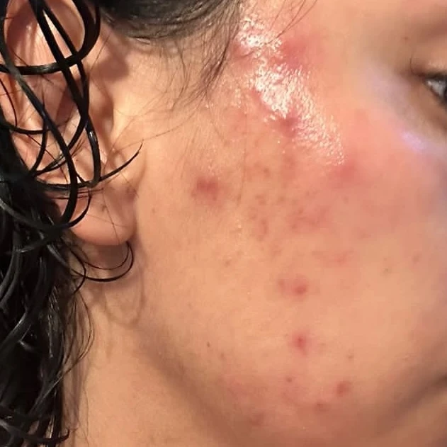 Tratamiento facial de acné