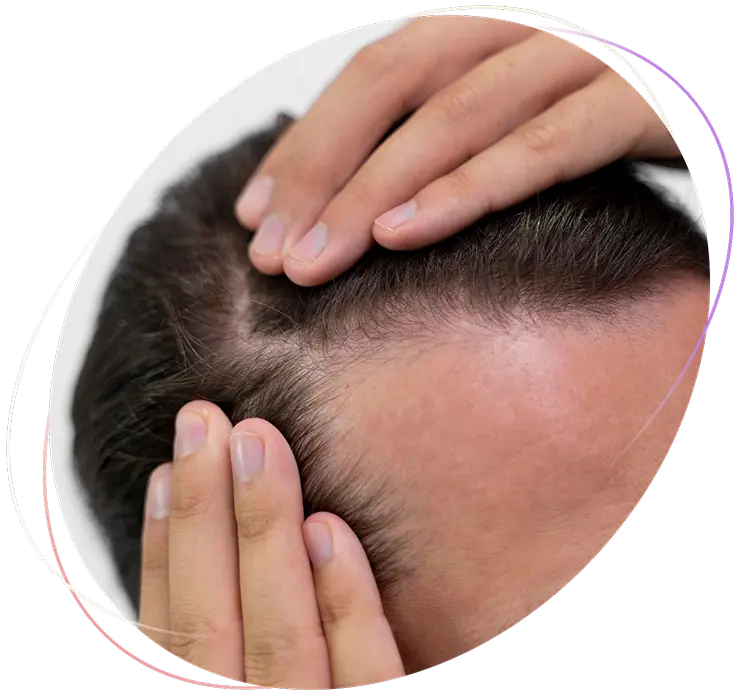 Tratamiento facial de alopecia