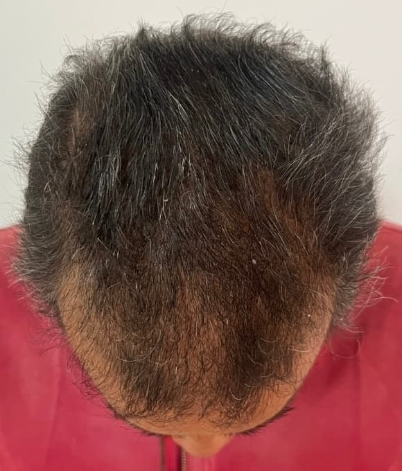 Tratamiento facial de alopecia