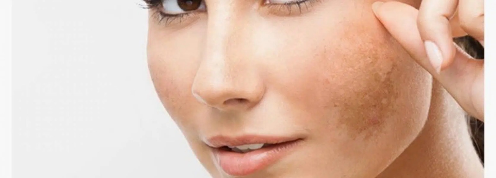 Melasma